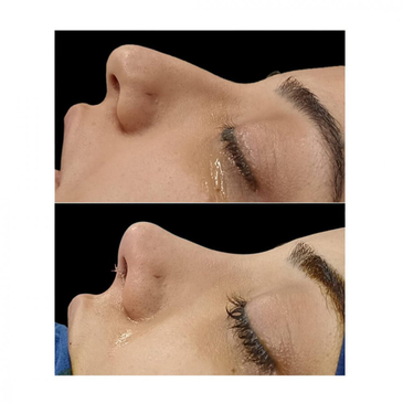 Slider image (2) The Nose Aesthetic Clinic